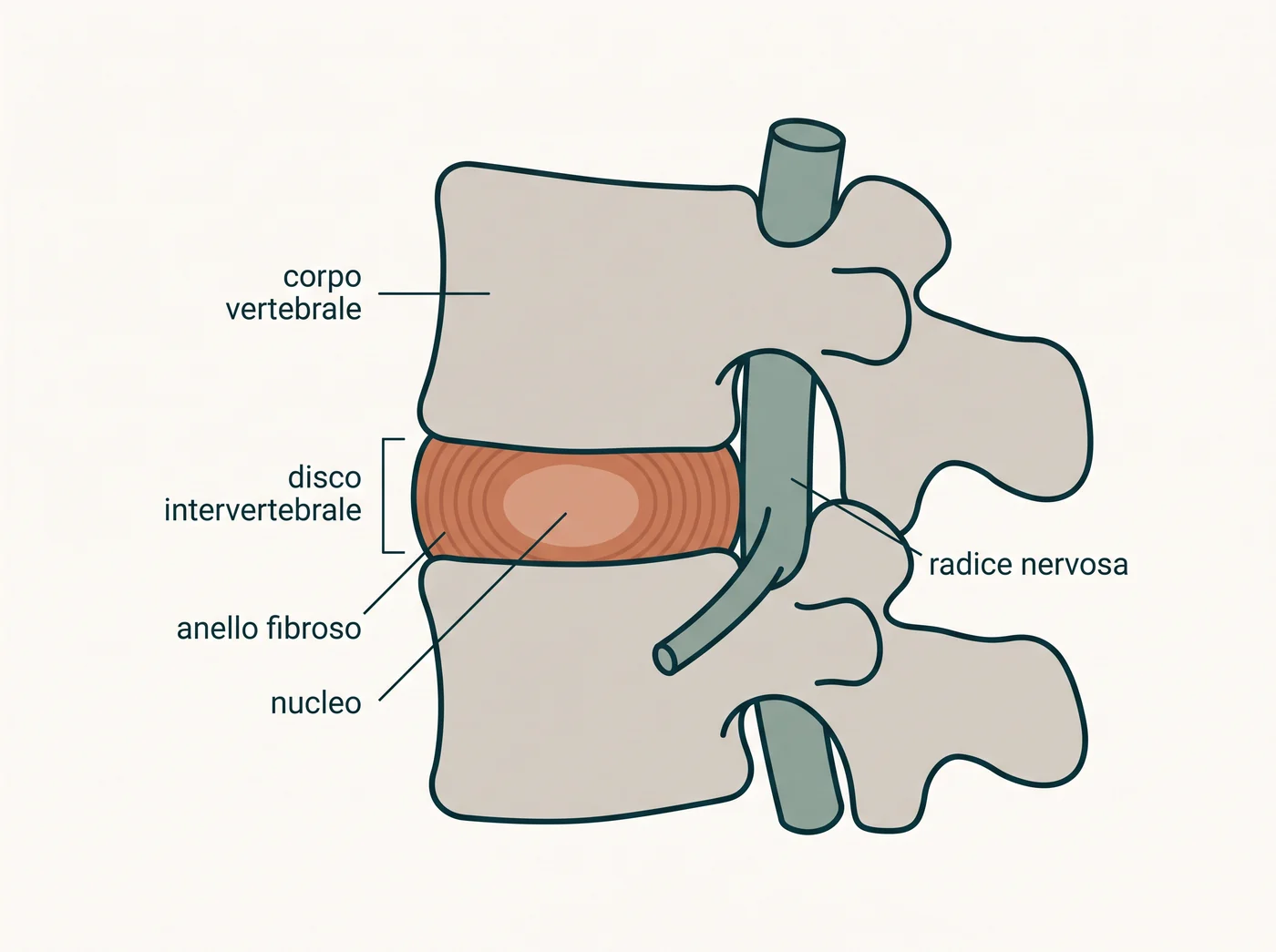 Illustrazione anatomica in sezione di due vertebre lombari con il disco intervertebrale, l'anello fibroso, il nucleo e la radice nervosa